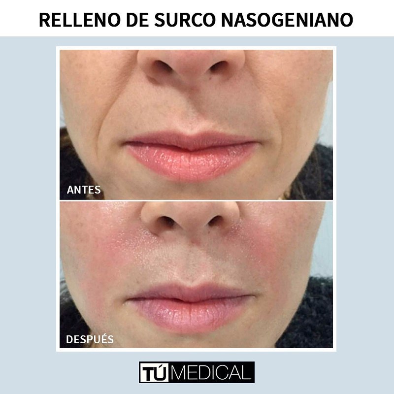 Surco Nasogeniano