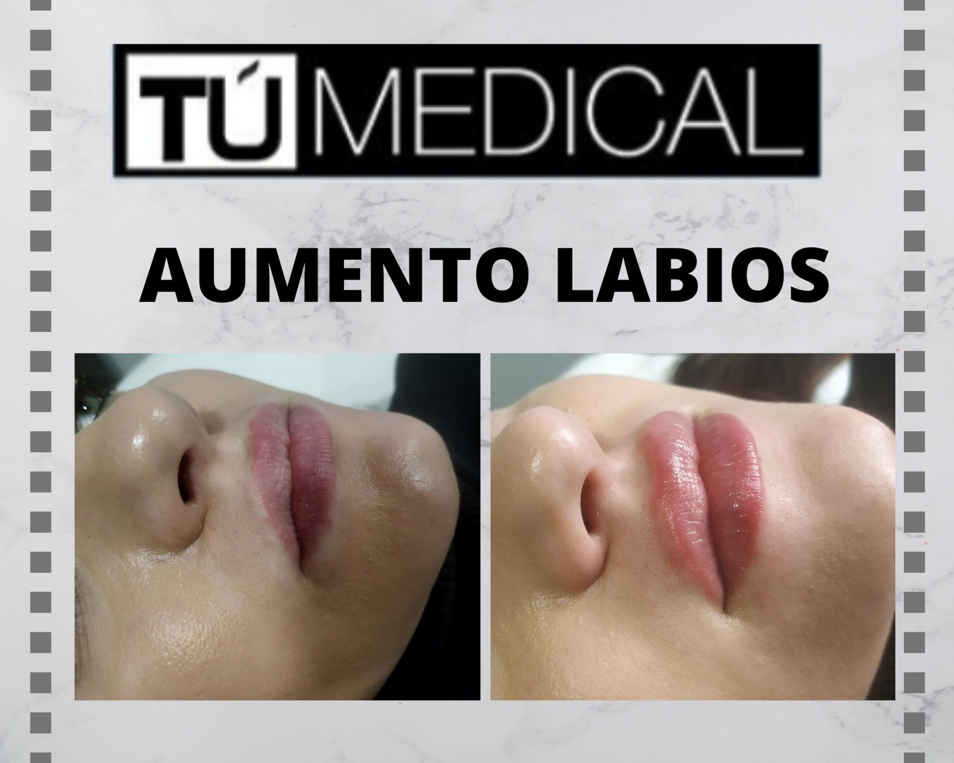 Resultados de Aumento de Labios con Ácido Hialurónico